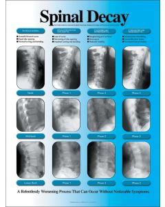 Tableau laminé, la discopathie dégénérative