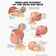 Whiplash Injuries (Head & Neck)