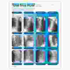 Right Spinal Decay Insert