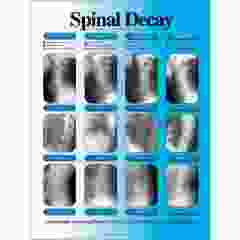 Laminated Spinal Decay Chart