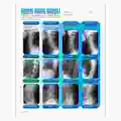 Left Spinal Decay Insert